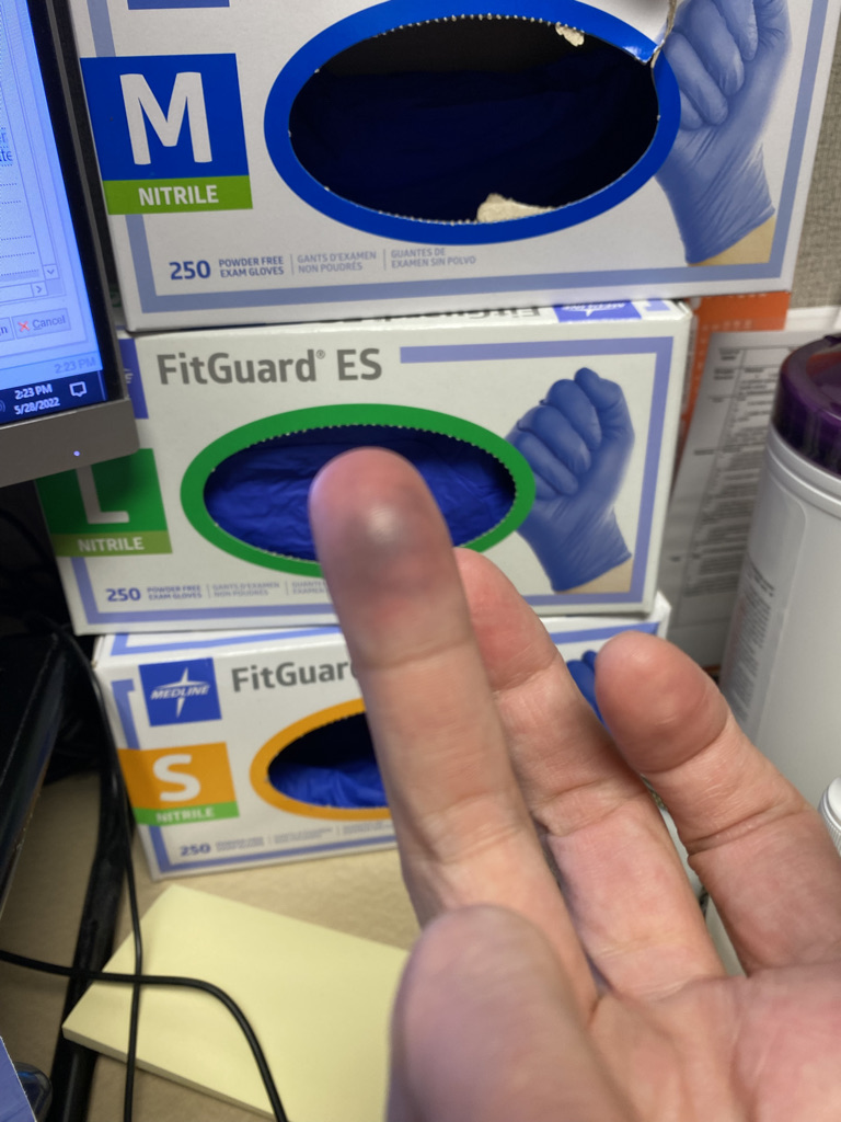 and the underside of the finger, it was tight for a few weeks