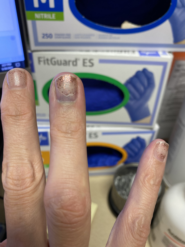 When you smash your finger and your husband immediately gets excited to drain the subungual hematoma
