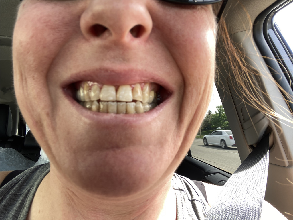 My amazing Dentist Dr Tolzman got the staining off :)