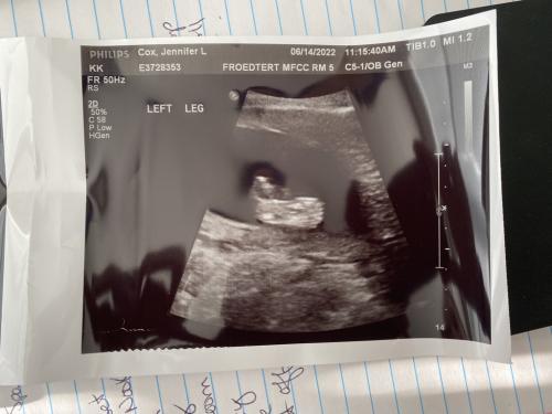 17 weeks left leg