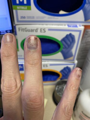 Busted finger
