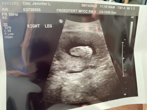 17 weeks right leg
